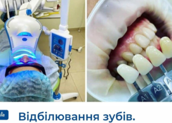 «Ангелія» пропонує процедуру відбілювання зубів